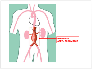 luca-dainese-fig-2-aorta-addominale