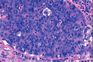 carcinoma-prostata-universita-trento-2