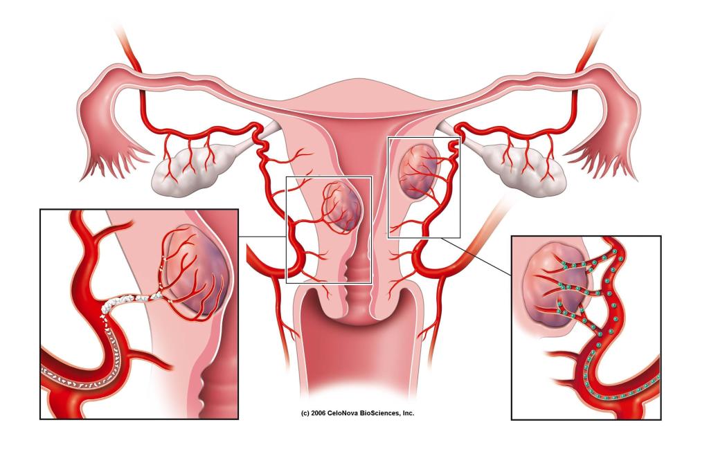 fibroma-uterino-stefano-pieri-ospedale-san-camillo-1