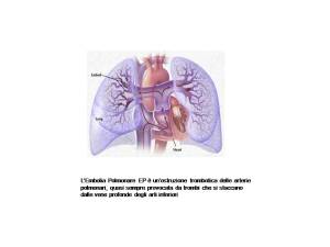 embolia-polmonare