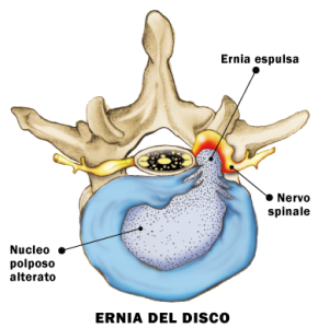 disco-con-ernia