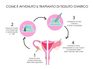 infografica-trapianto-tessuto-ovarico