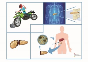 infografica-autotrapianto-isole-pancreatiche