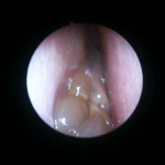 Fig. 3 - Polipi nasali nella cavità nasale destra