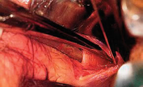 sfinterotomia-laterale-interna