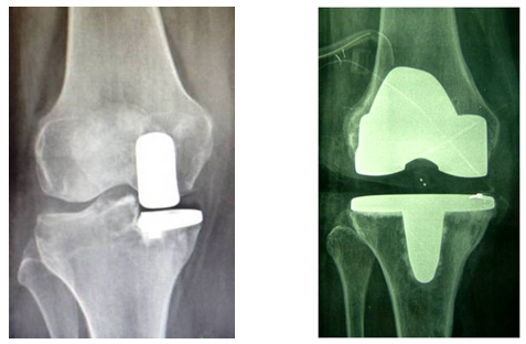 protesi-artrosi-ginocchio-camilleri-fig-1