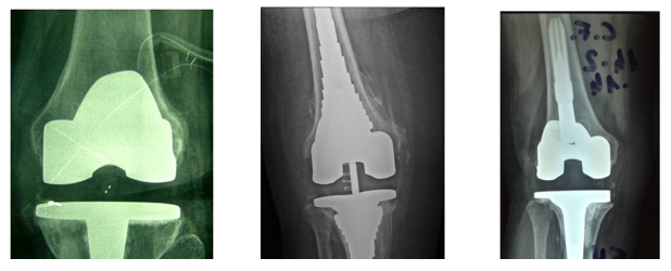 protesi-artrosi-ginocchio-camilleri-fig-4