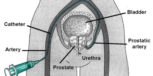 prostata-arezzo