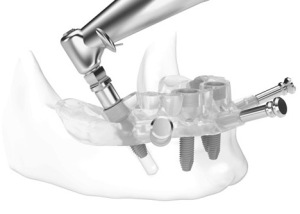 implantologia-dentale-virtuale-3d-mauriziano-2