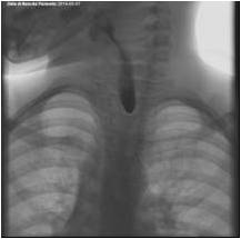 figura-1-radiografia-fratellini-ingestione-soda-caustica-torino