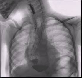 figura-2-radiografia-fratellini-ingestione-soda-caustica-torino
