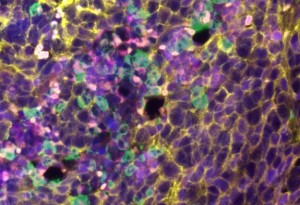 cellule-mieloidi-prostata-alimonti