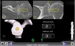 navigazione-intra-operatoria-protesi-spalla-aou-pisana