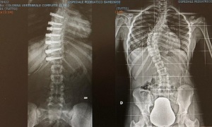 radiografia-colonna-vertebrale-opbg
